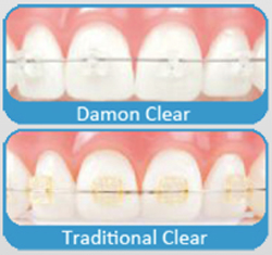 Invisalign Provide