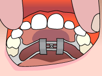 Invisalign Provide
