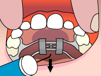 Invisalign Provide