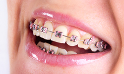 Invisalign Provide