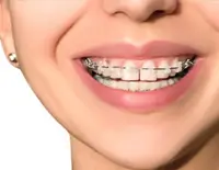 types-of-braces-mega