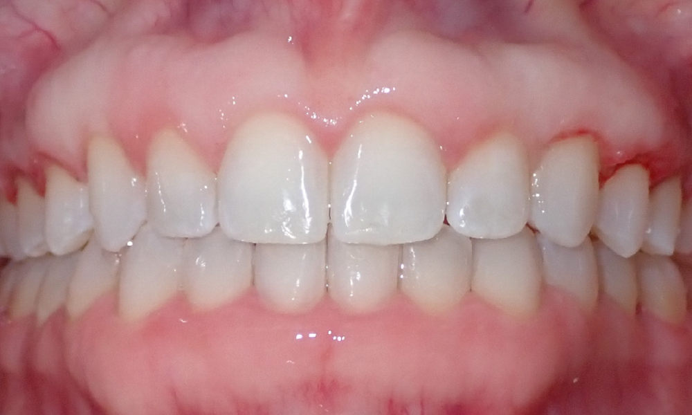 Bridget-Saldarriaga-Center Intra-Oral-FINAL