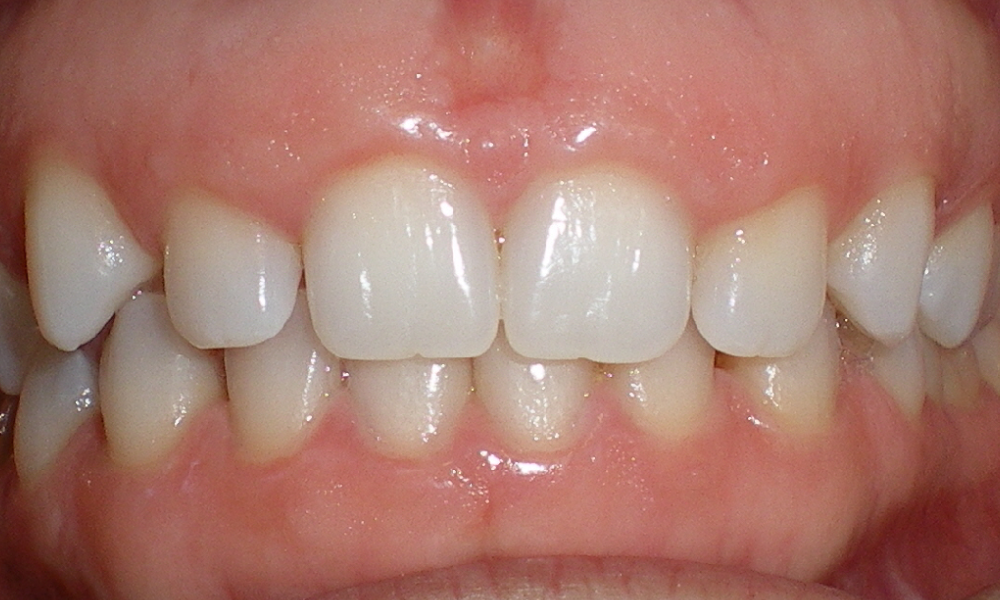 Bridget-Saldarriaga-Center-Intra-Oral-INITIAL