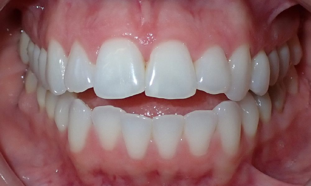Estefeni-Estremera-Center-Intra-Oral-INITIAL