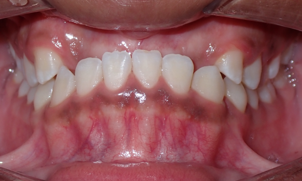 Isaiah-Cruz-Center-Intra-Oral-INITIAL
