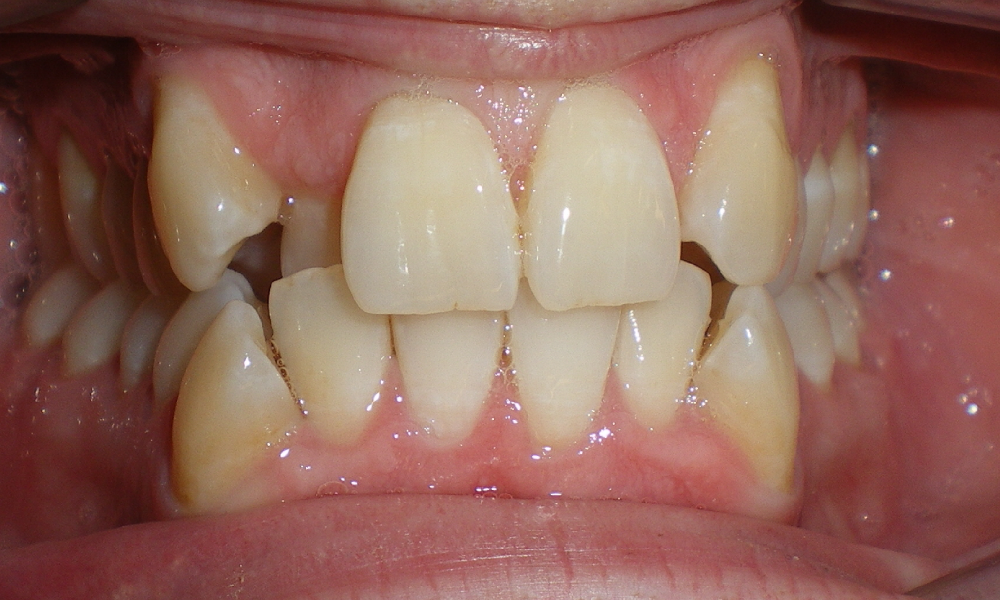Justin-Crawford-Center-Intra-Oral-INITIAL