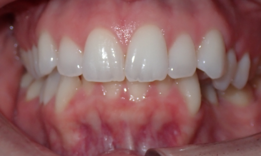 Kristen-Cataldi-Center-Intra-Oral-INITIAL