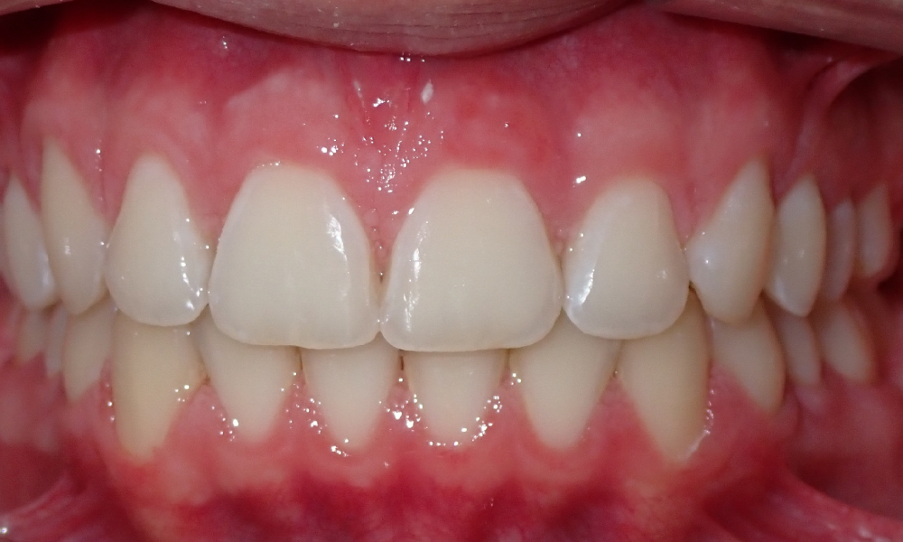 Matthew-Boccassini-Center-Intra-Oral-FINAL