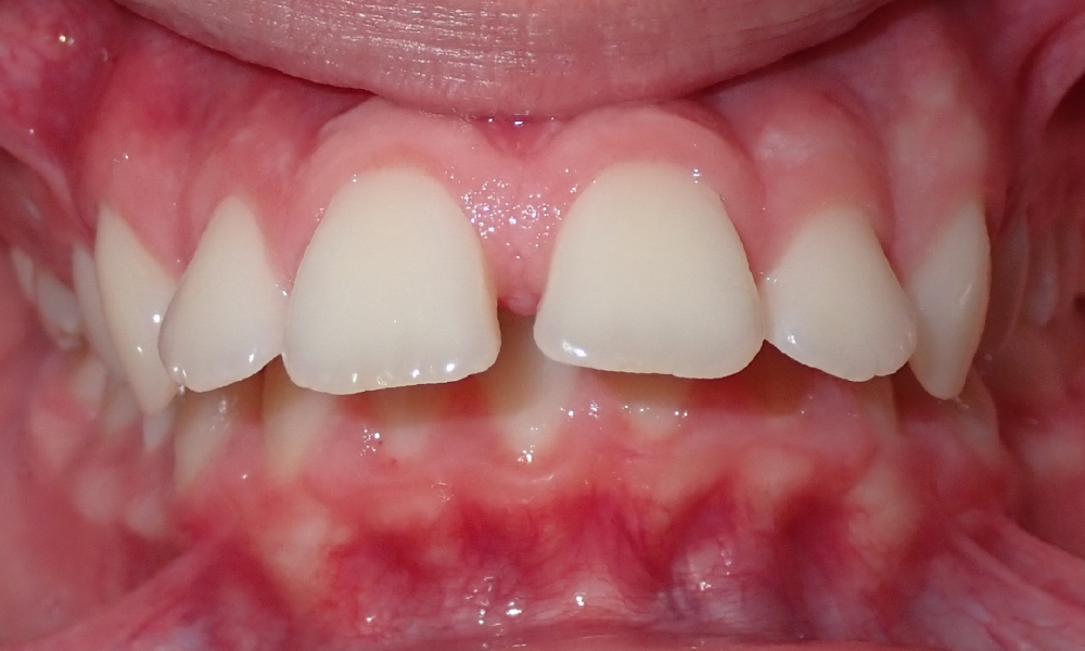 Matthew-Boccassini-Center-Intra-Oral