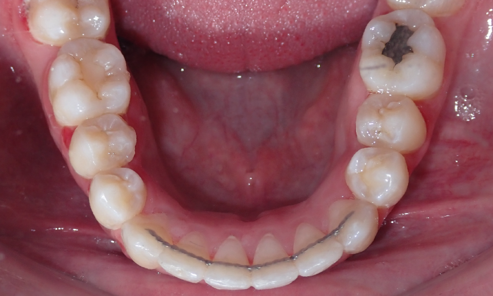 Nydializ-Velaquez-Mand-Occlusal-FINAL