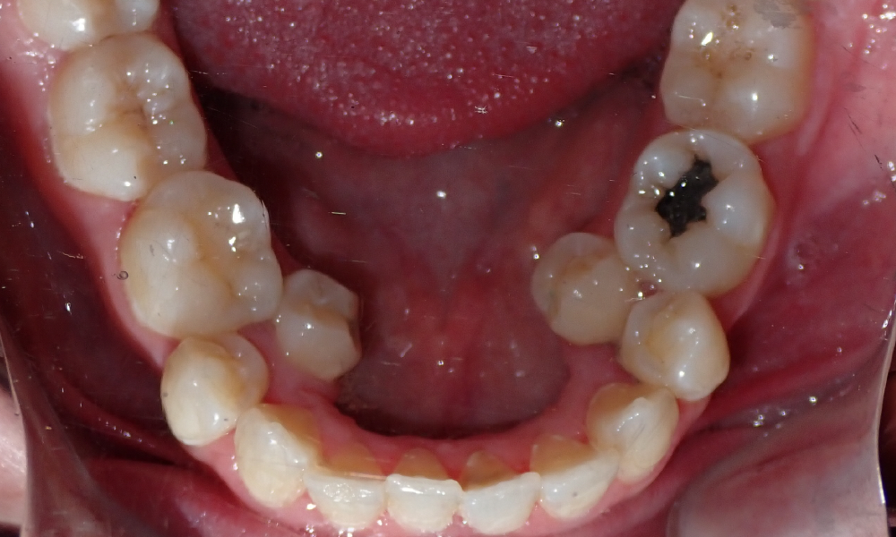 Nydializ-Velaquez-Mand-Occlusal-INITIAL